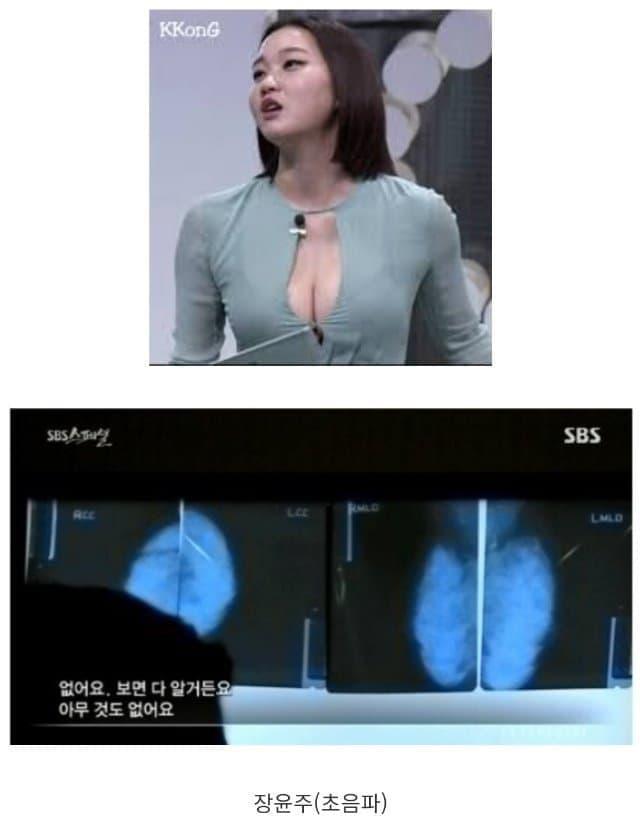 가슴성형 의혹에 엑스레이 공개한 유명인들