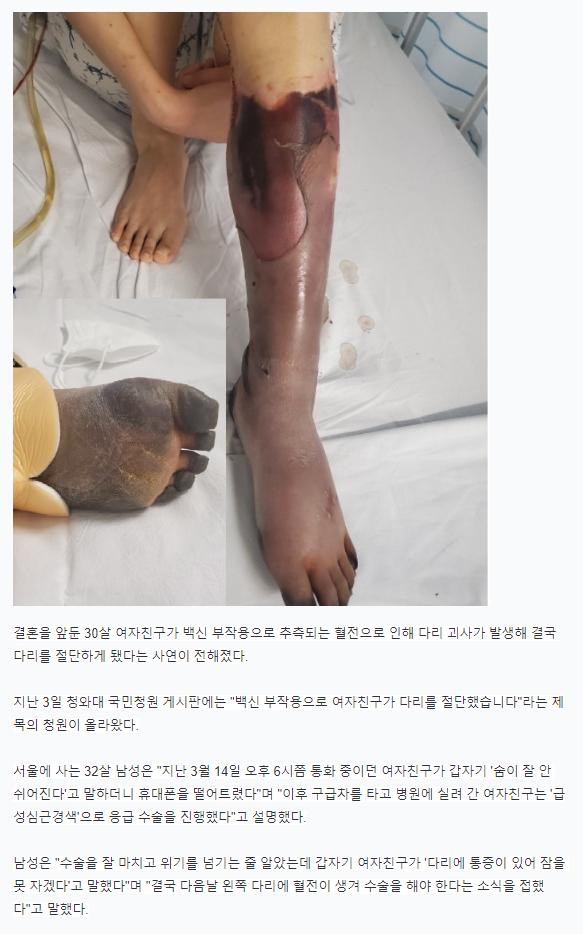 결혼약속 30세 여친, 백신 접종 뒤 다리 괴사해 절단 남친 울분