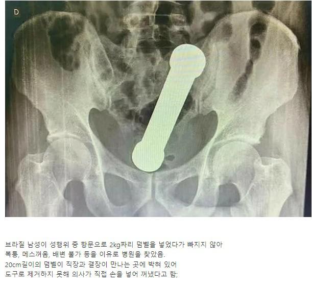 브라질 남성의 장에서 발견된 